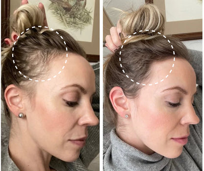 Capstone™ HairFall Control Device